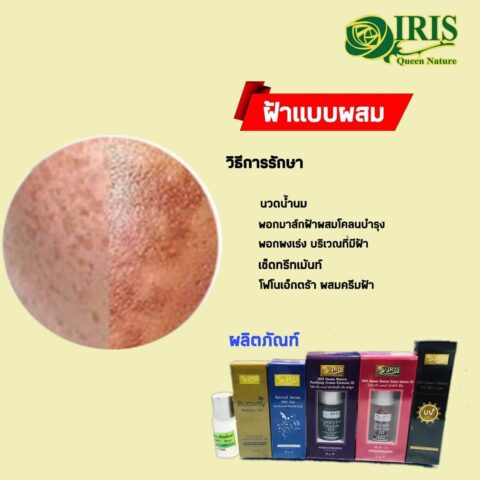 เซตรักษาฝ้าผสม