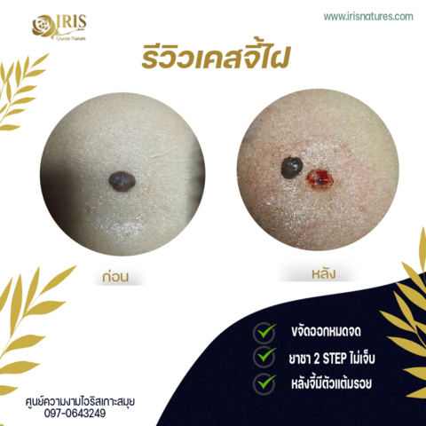 จี้ไฝ/หูด/ติ่งเนื้อ..